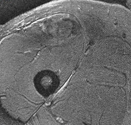 Figure 3 for case rectus femoris indirect head proximal myotendinous junction tear with hematoma( RID2698 )